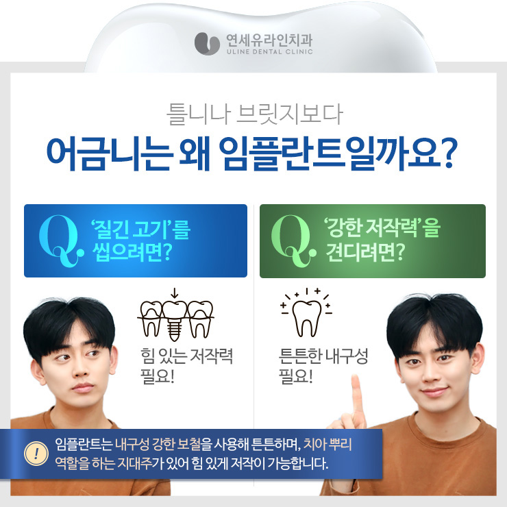 관악구치과 어금니임플란트가격대비 끝내줘 관련 이미지 2