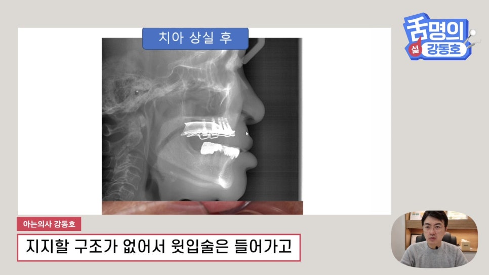 Dental Implants at Sillim Station: When There Is Not Enough Jawbone image 3
