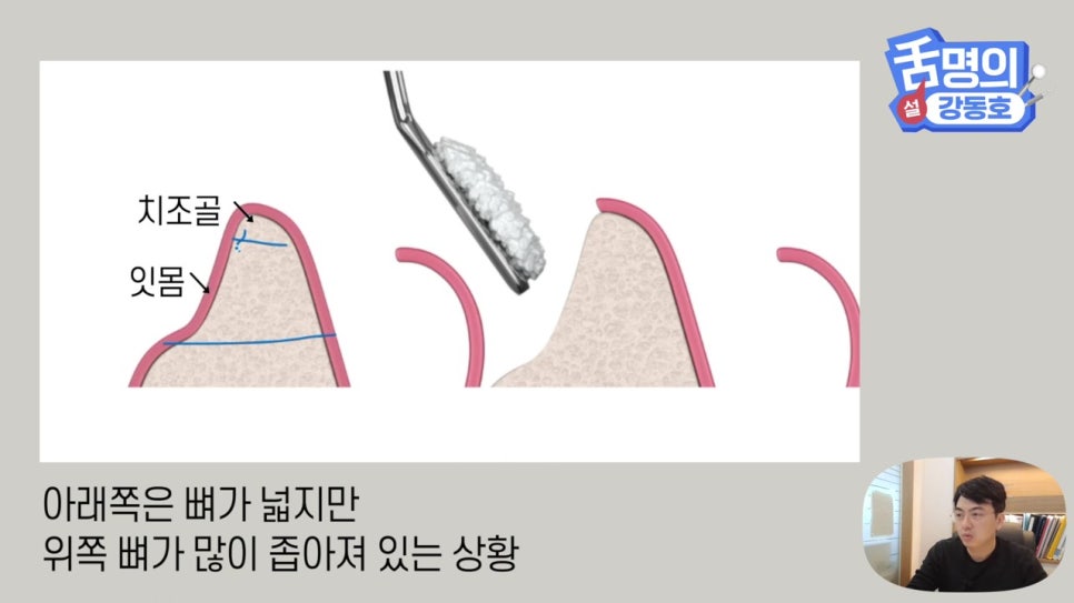 강남역임플란트, 뼈이식 왜 필요해? 관련 이미지 13