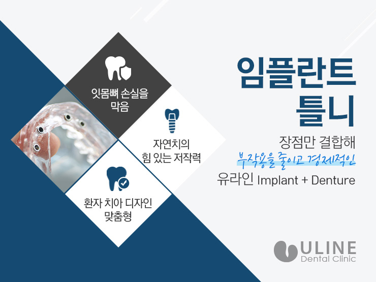 임플란트틀니기간 줄이고 기술은 높였다 관련 이미지 6