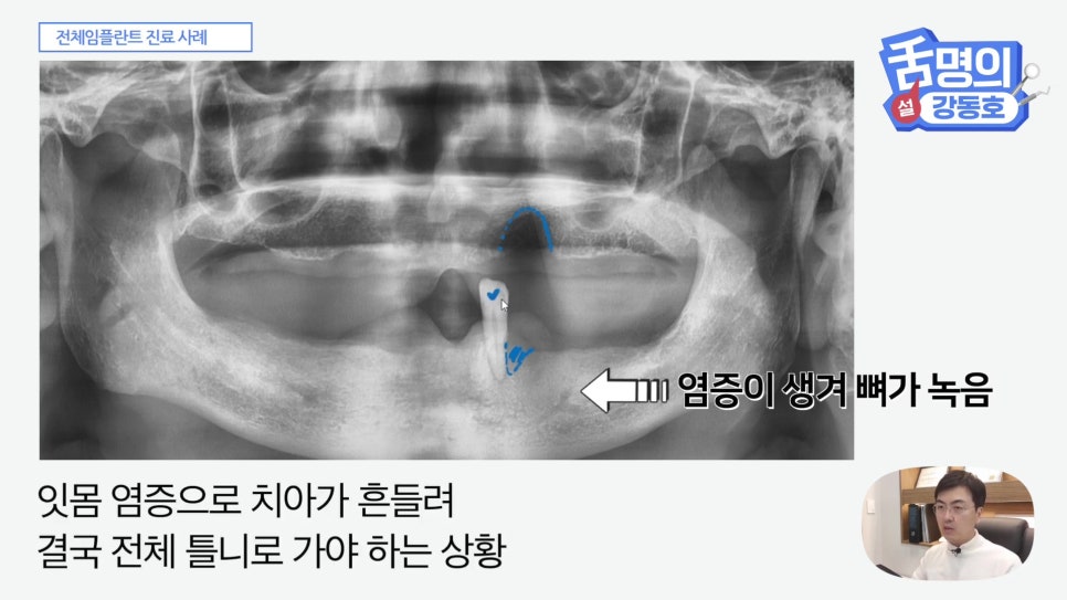 관악구치과 - 전체 임플란트, 시간&middot;횟수&middot;개수 총정리 관련 이미지 3