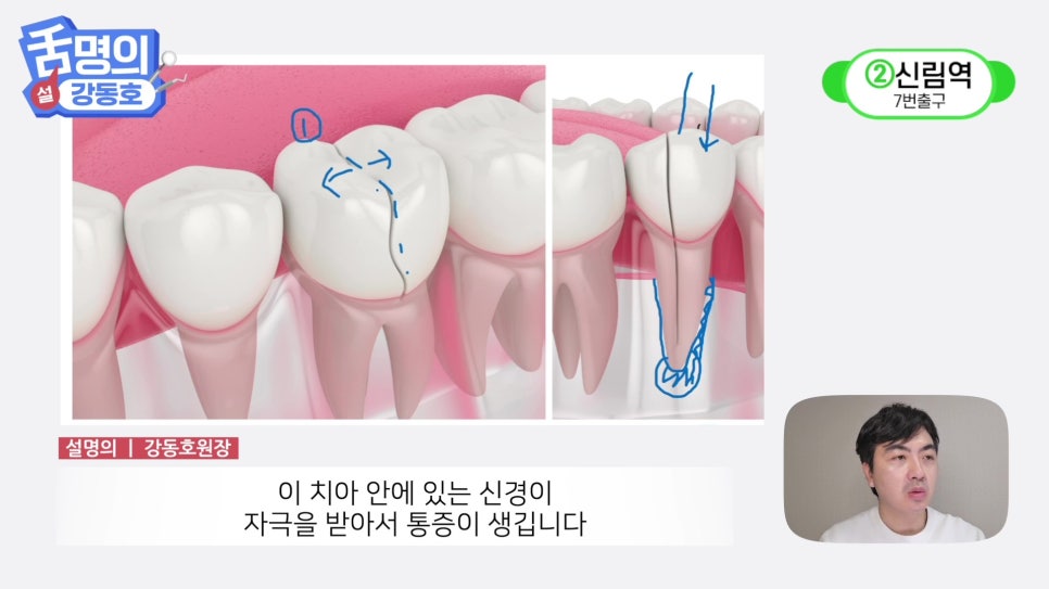 Sillim Station Dentist - Why Does It Hurt When Chewing? image 22