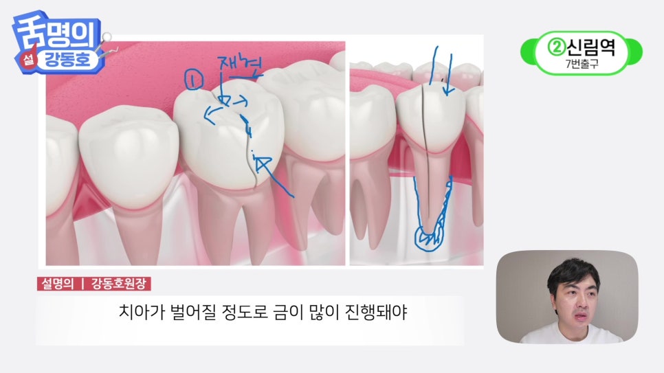 Sillim Station Dentist - Why Does It Hurt When Chewing? image 23