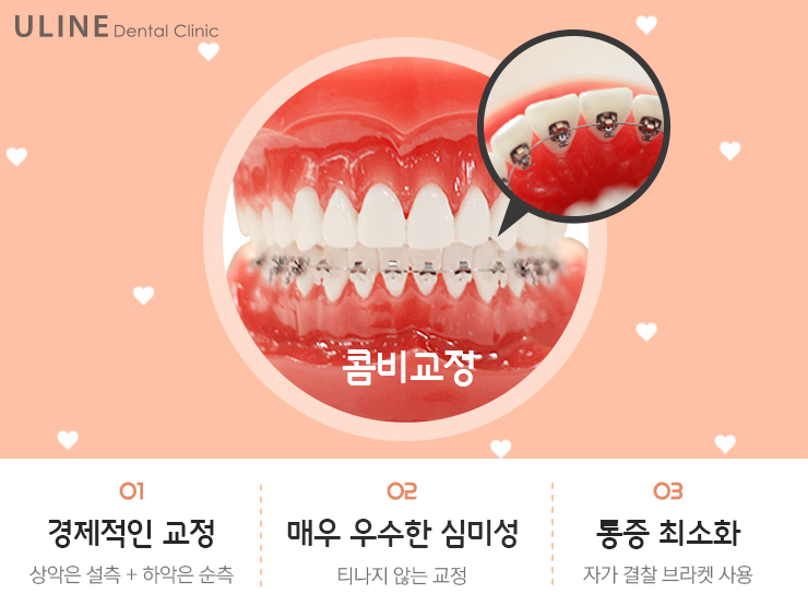 치아교정 종류 고민이시라면 이건어때요!? 관련 이미지 3