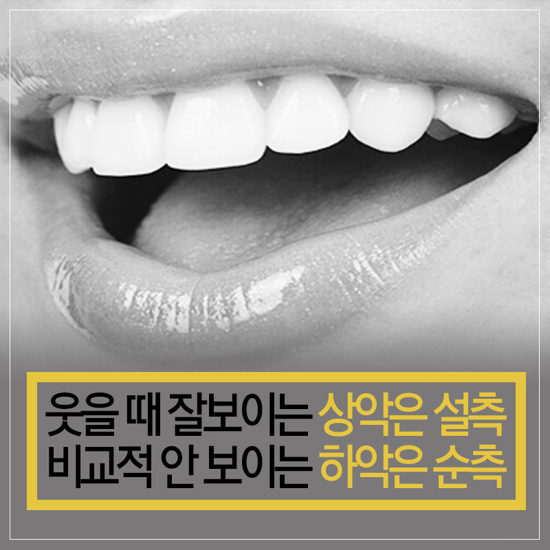 덧니설측교정 물론 가능하죠 관련 이미지 6