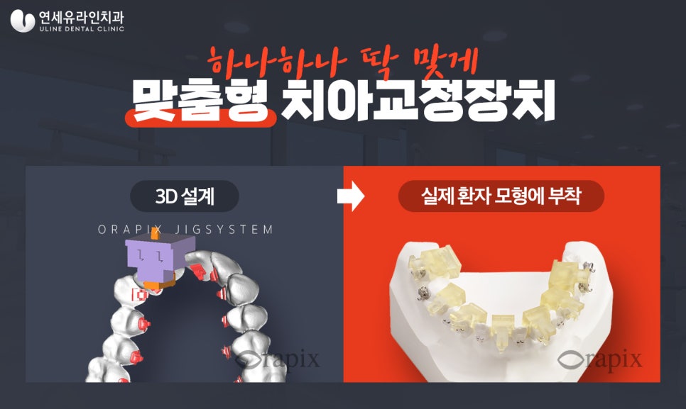 신림역치과 앞니 아랫니만 쉽고 간단하게! 관련 이미지 7