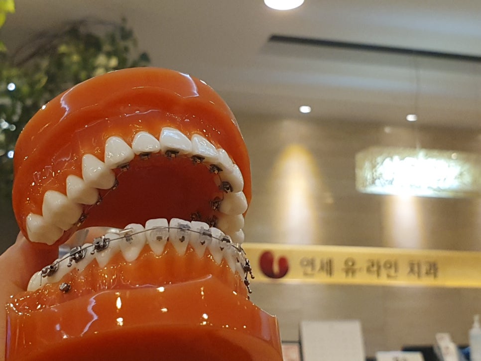 설측교정후기 생활에 지장없이 관련 이미지 3