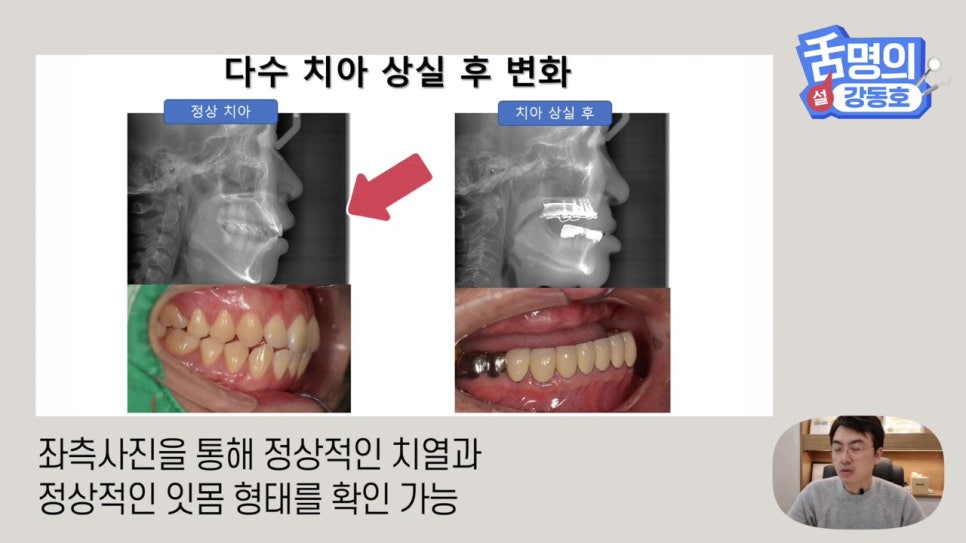 신림동치과, 다수의 치아상실 후.. 관련 이미지 3