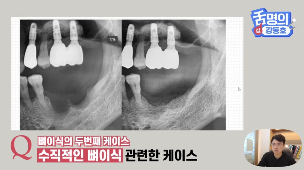 강남역임플란트, 뼈이식 왜 필요해? 관련 이미지 18