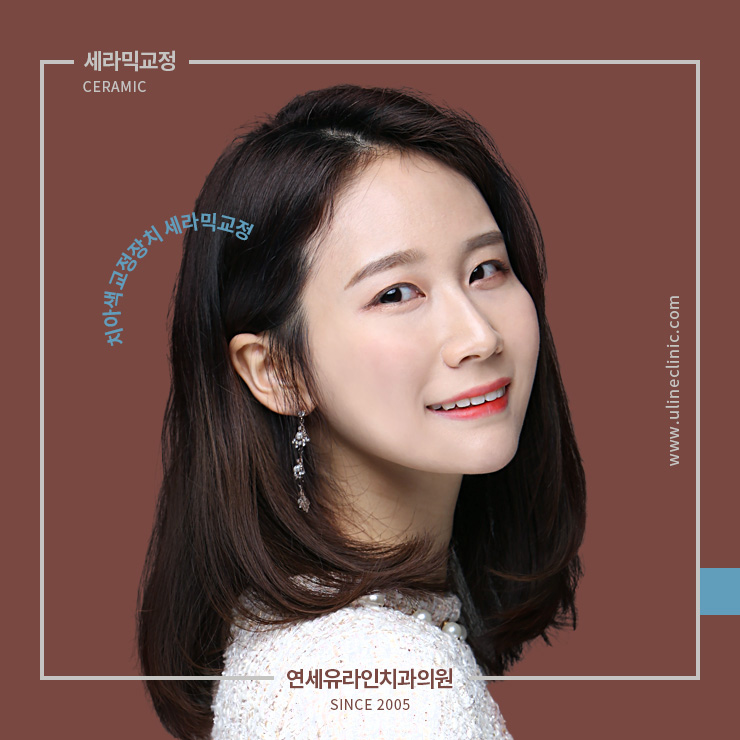 세라믹교정후기 오늘부터 시작할래 관련 이미지 1