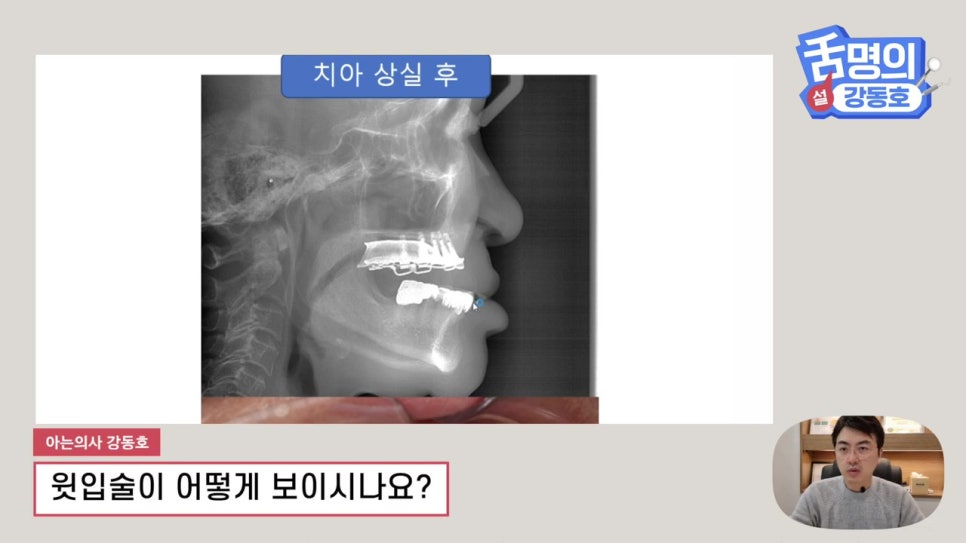 신림동치과, 다수의 치아상실 후.. 관련 이미지 4
