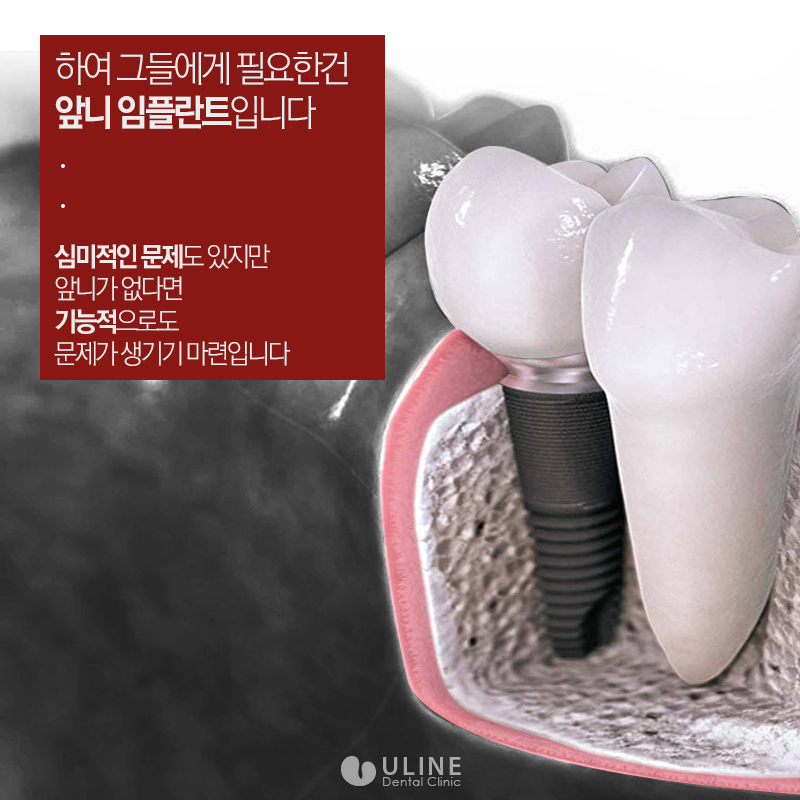 앞니임플란트가격 결과 모두 좋아 관련 이미지 3