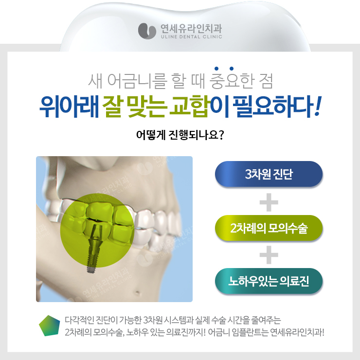 관악구치과 어금니임플란트가격대비 끝내줘 관련 이미지 5