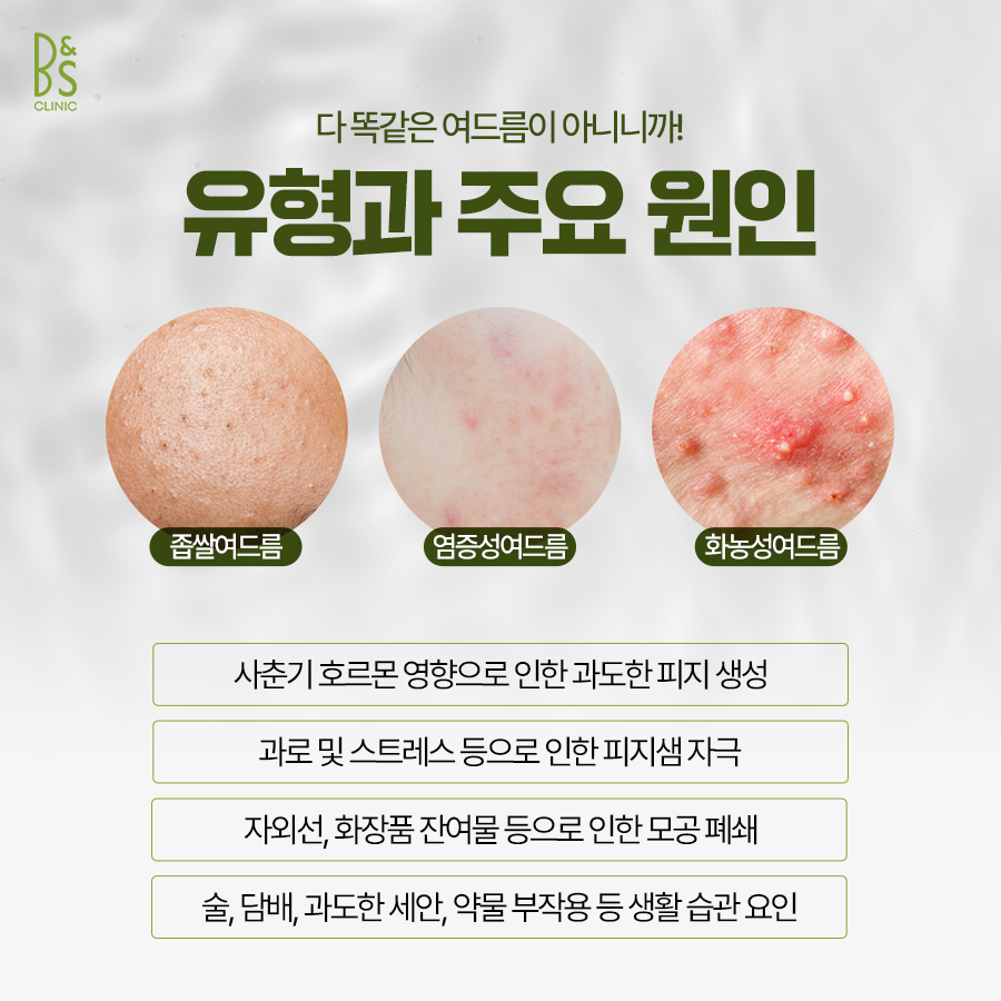 Cause of Recurrent Skin Troubles at Samseong Station Acne Dermatology image 5