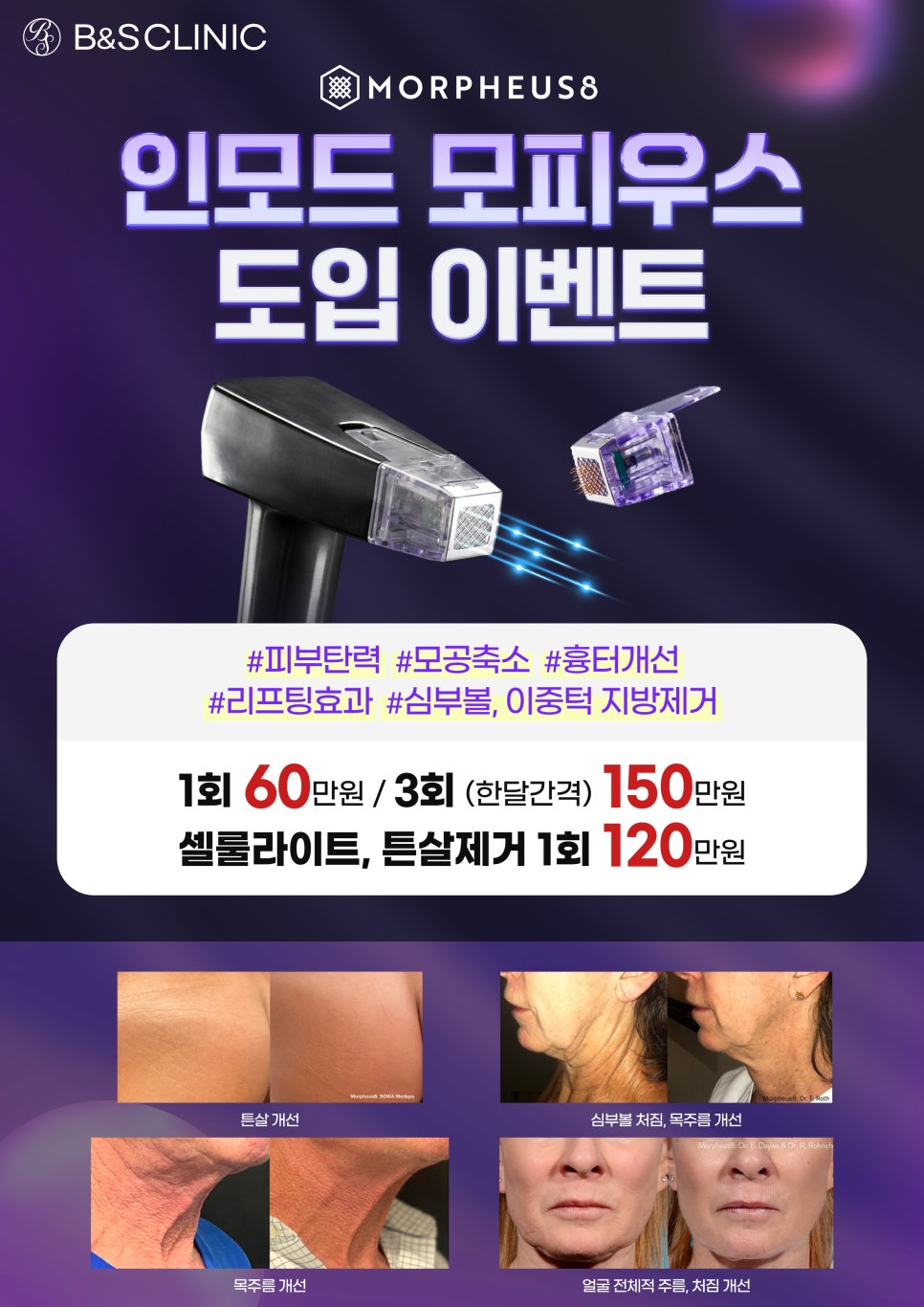 [EVENT] B&S 인모드 모피우스 도입 기념 혜택가! 관련 이미지 1