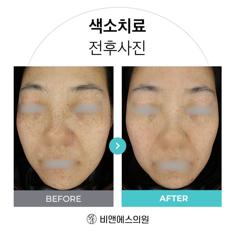 코엑스피부과 삼성비앤에스 색소치료 전후 CASE 관련 이미지 1