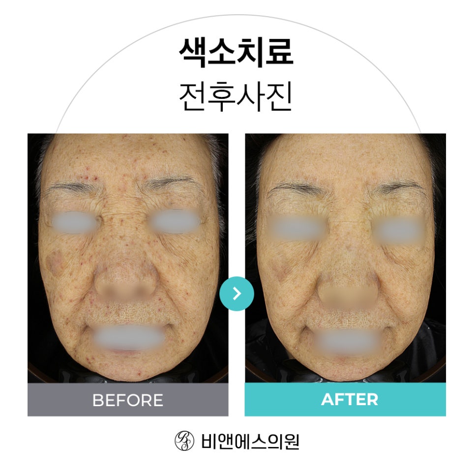 코엑스피부과 삼성비앤에스 색소치료 전후 CASE 관련 이미지 3