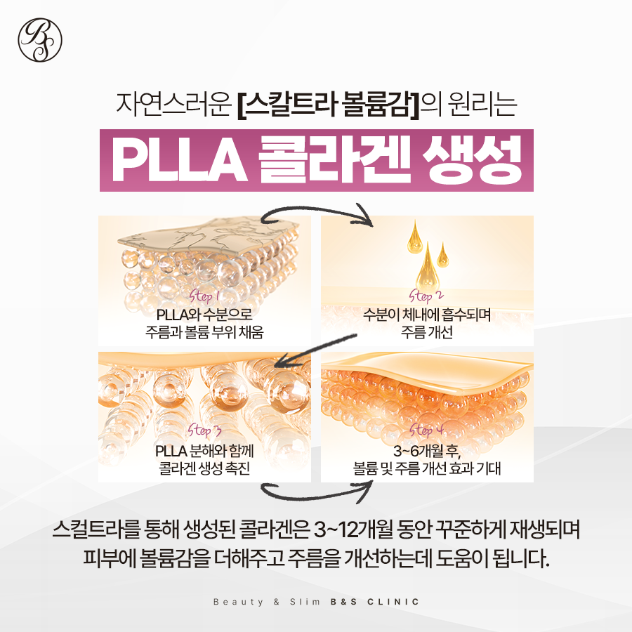 역삼동피부과 필러의 아쉬움 스컬트라로 관련 이미지 3
