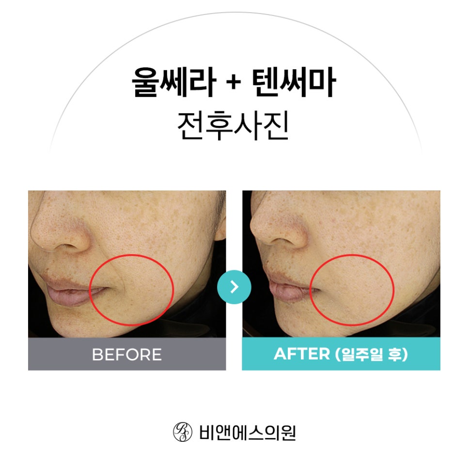 [EVENT] 전후사진 보고 챙기는 텐써마 혜택! 관련 이미지 1