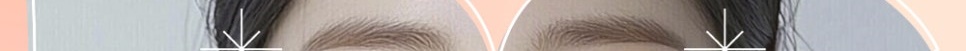 How Is Jubeugen Able to Improve Nasolabial Folds? image 14