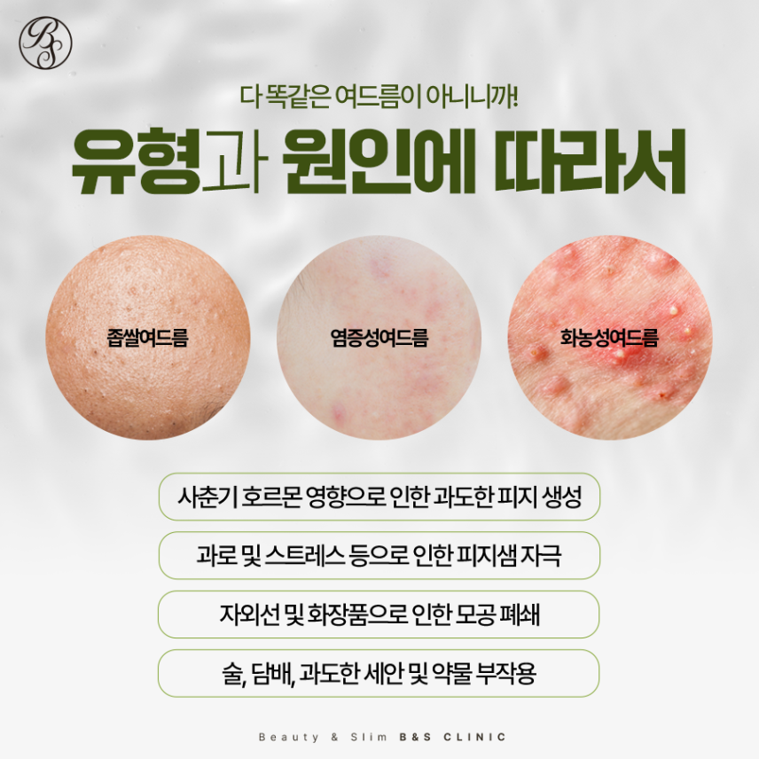 선릉역피부과추천 여드름성 피부가 고민일 때 관련 이미지 5