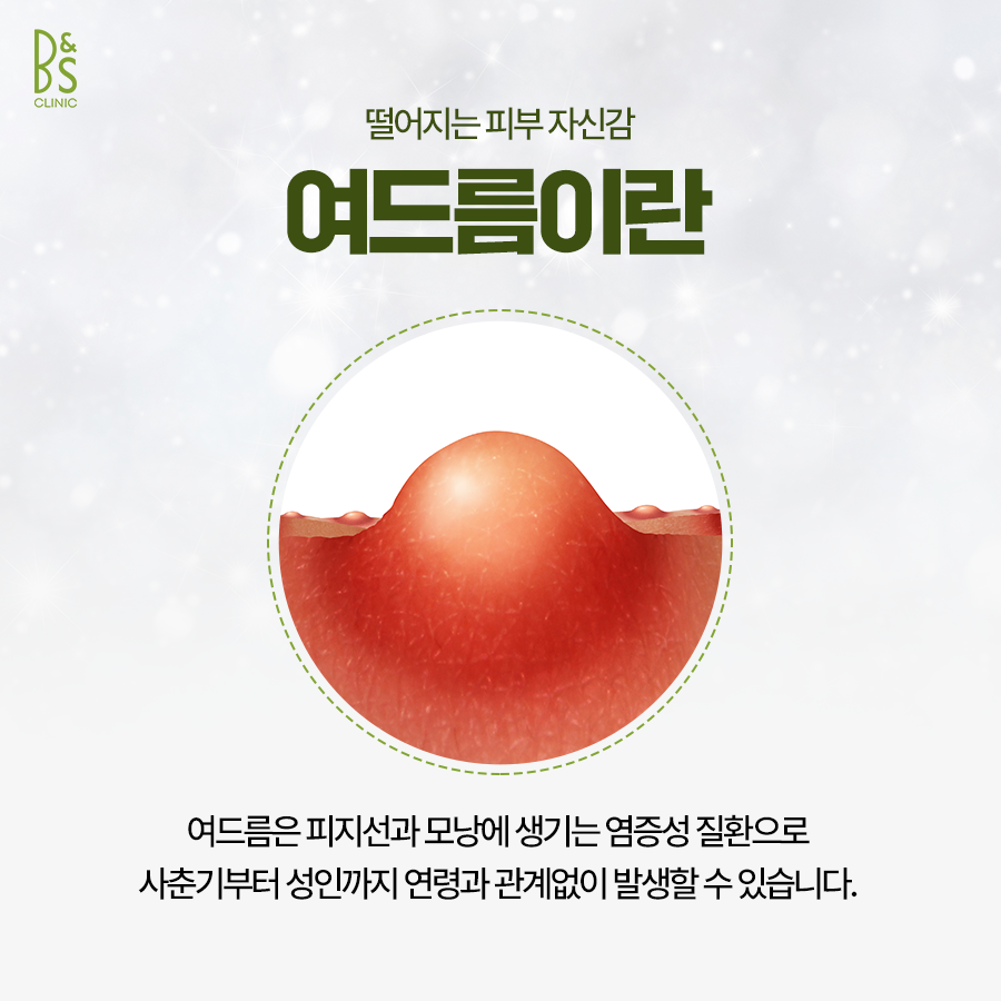 Cause of Recurrent Skin Troubles at Samseong Station Acne Dermatology image 3