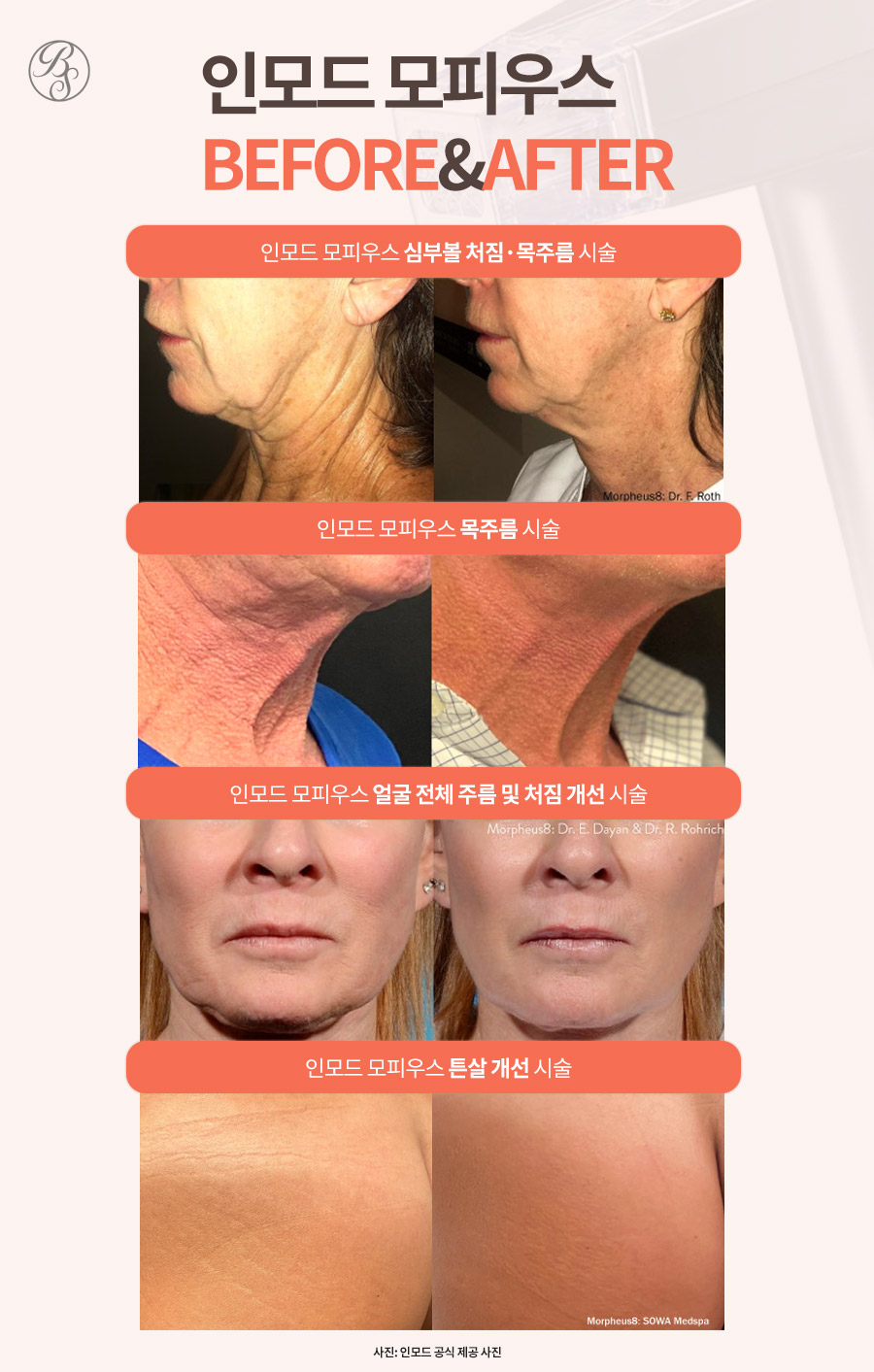 코엑스피부과 인모드 모피우스8 효과와 주의사항까지 관련 이미지 10