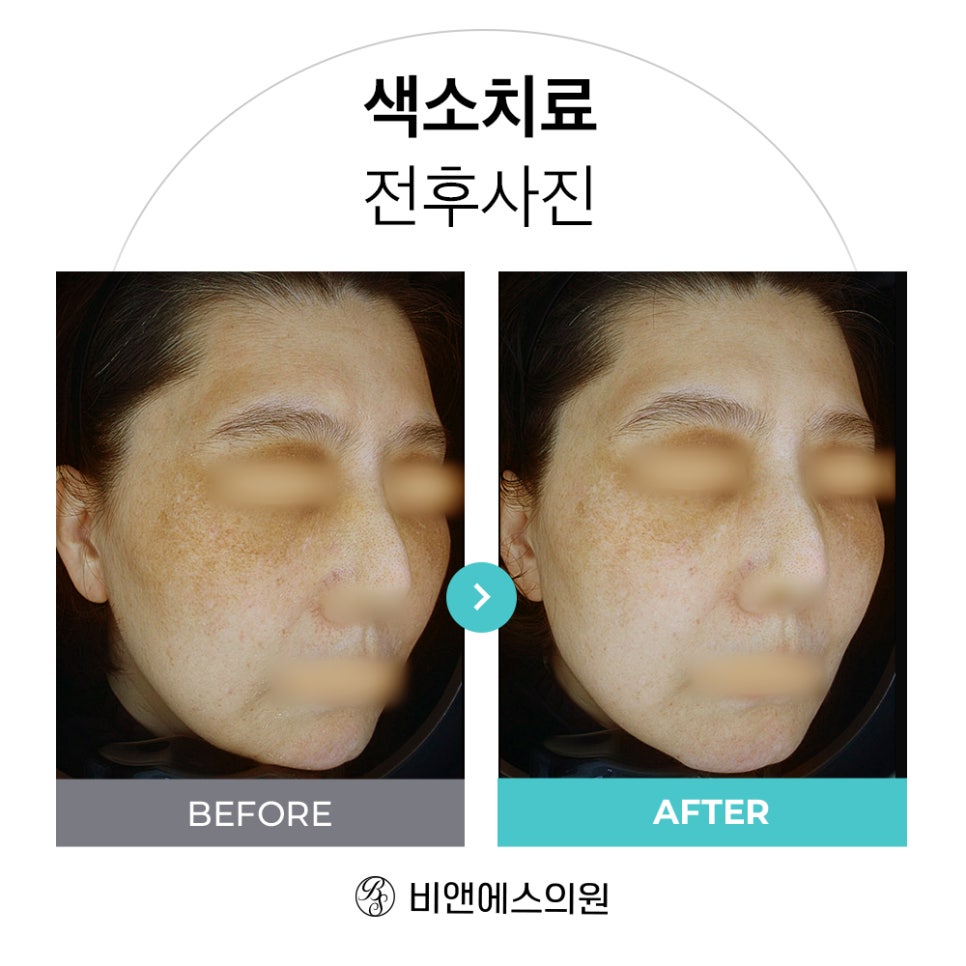 코엑스피부과 삼성비앤에스 색소치료 전후 CASE 관련 이미지 4