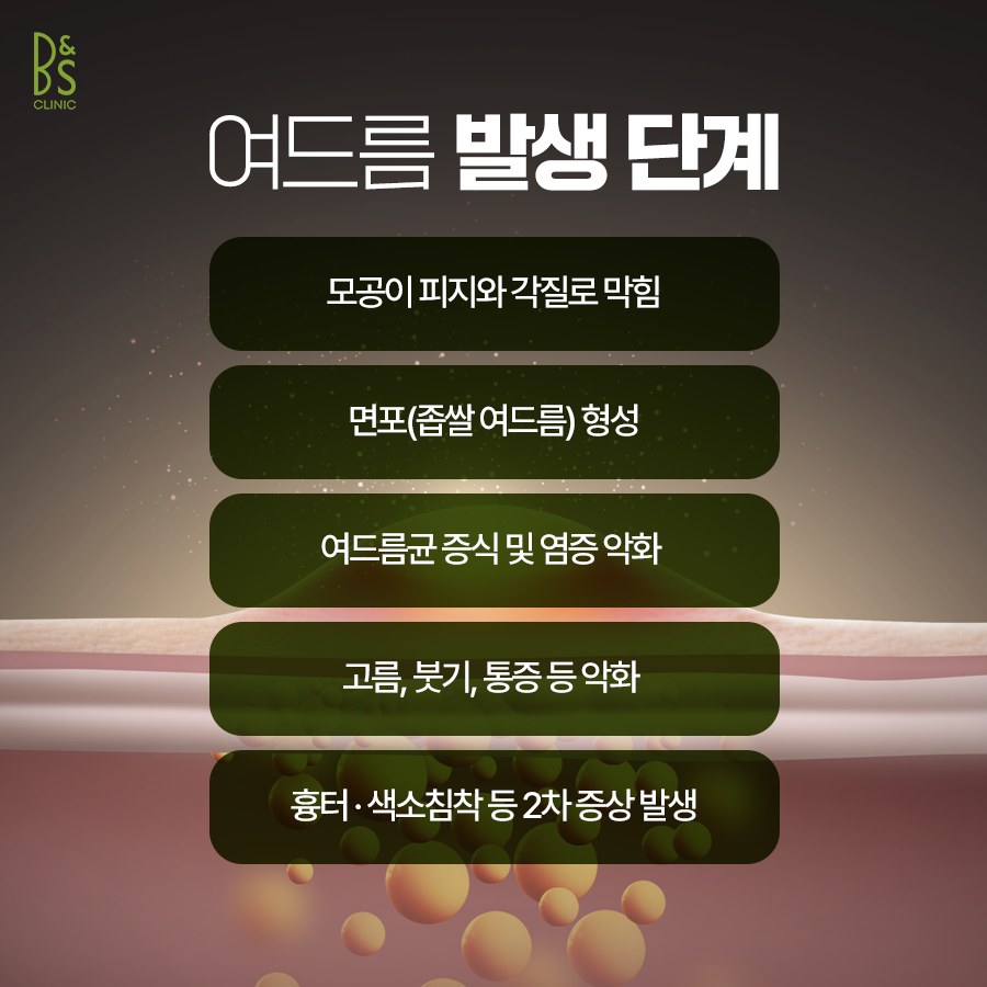Cause of Recurrent Skin Troubles at Samseong Station Acne Dermatology image 6