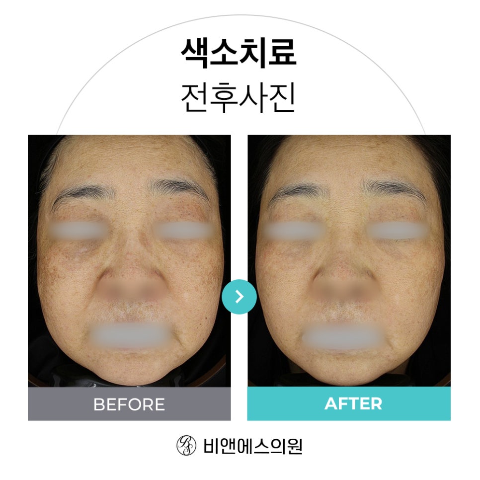 코엑스피부과 삼성비앤에스 색소치료 전후 CASE 관련 이미지 2