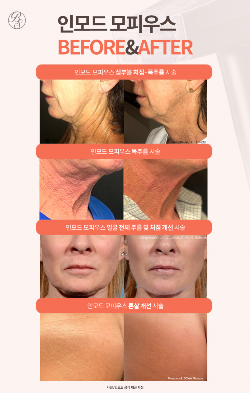 삼성역인모드 탄력 변화부터 다르게 느껴요 관련 이미지 7