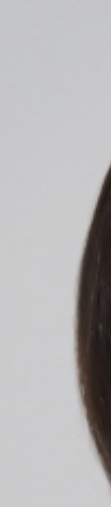 삼성역보톡스 시술 전 알아두면 좋은 정보 관련 이미지 14