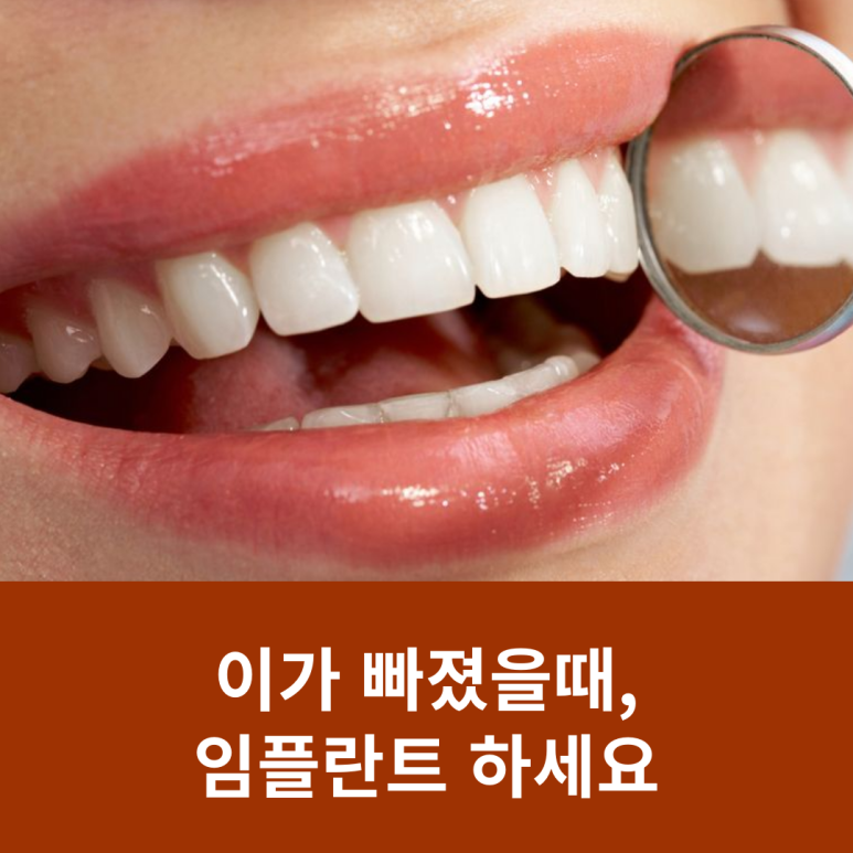 이가 빠졌을때, 임플란트 하세요 관련 이미지 7