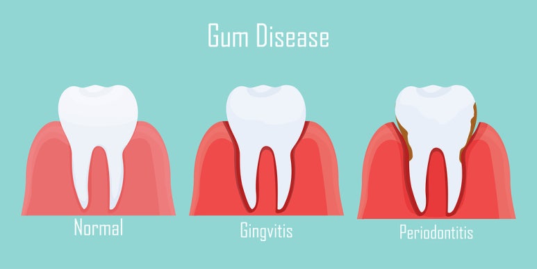 Implant Lifespan: Using It Longer with Proper Care image 3