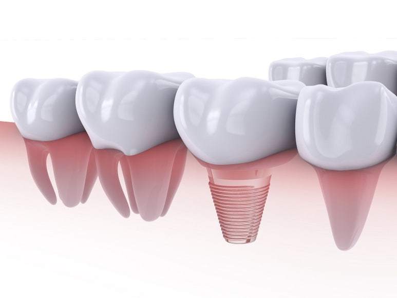 Implant Surgery Methods and Common Questions, Explained by Seokplant Dental Hospital. image 1