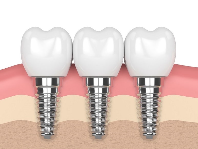 What Is Full-Mouth Implant Treatment? image 3