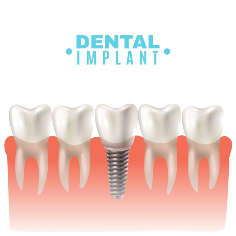 Thinking About Implants for Your Parents? image 3