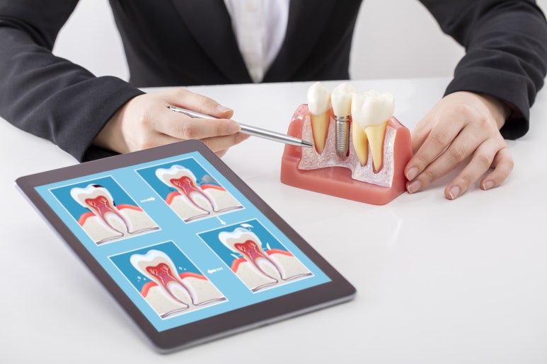 Seok Implant? If you’re getting implants, learn about Seok Plant Dental Hospital image 4