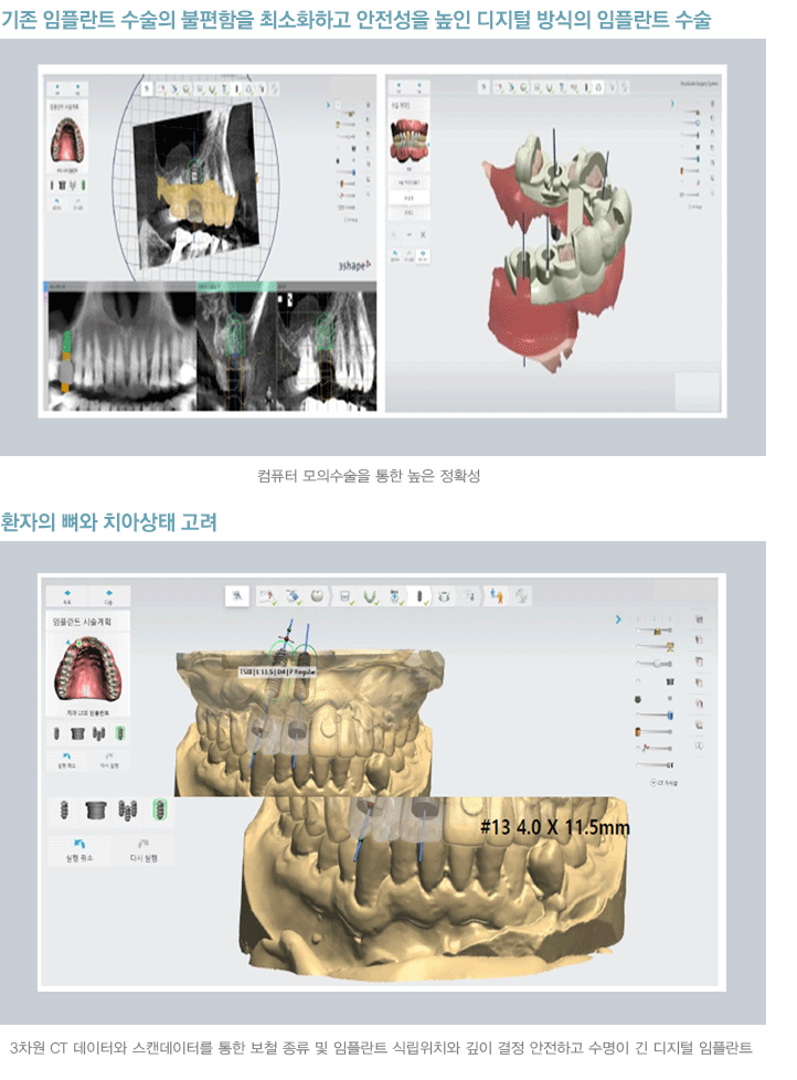 Implant Treatment Transformed by Digital Technology: Navigation Implants image 4