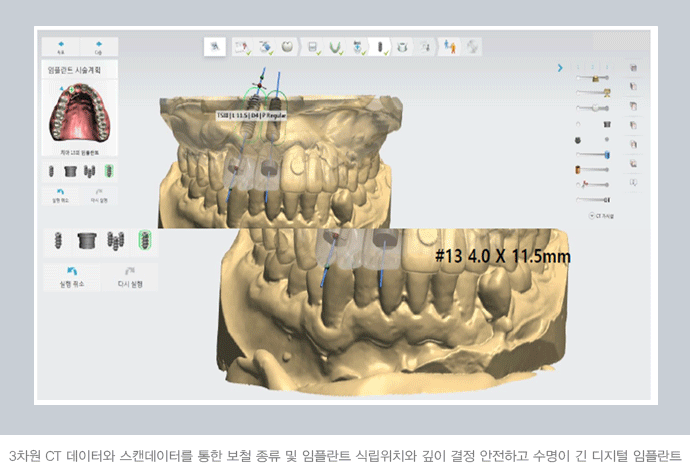 Digital Implants: More Precise, More Comfortable image 3