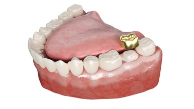 Prosthodontic Treatment: What You’re Curious About! Part 1 image 3