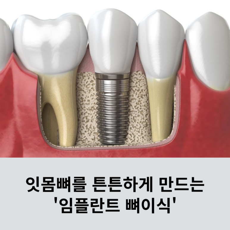 Making the Jawbone Stronger image 8