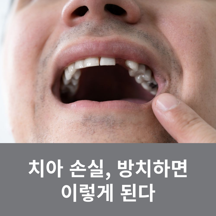 This Is What Happens If Tooth Loss Is Left Untreated image 5
