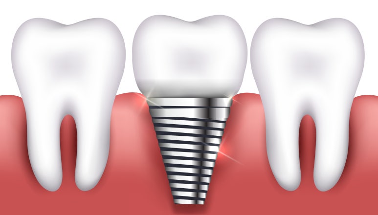 What Are the Types of Implants? Seokplant Dental Hospital image 1