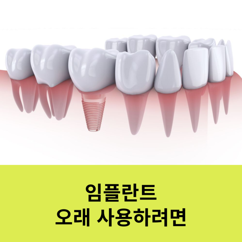 임플란트 오래 사용하려면 관련 이미지 9