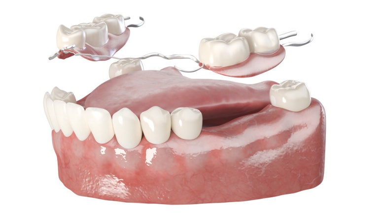 Countless Dental Concerns? Leave Them to Implants! image 5