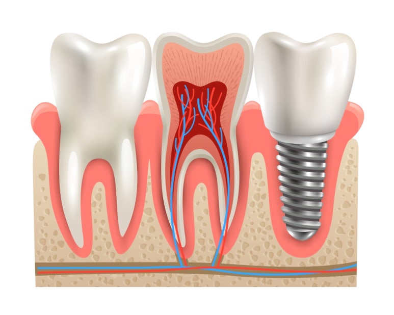 Seokplant Information on the Need for Implant Bone Graft Prices and Related Matters image 6