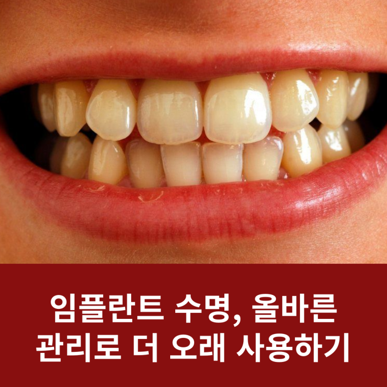 Implant Lifespan: Using It Longer with Proper Care image 11