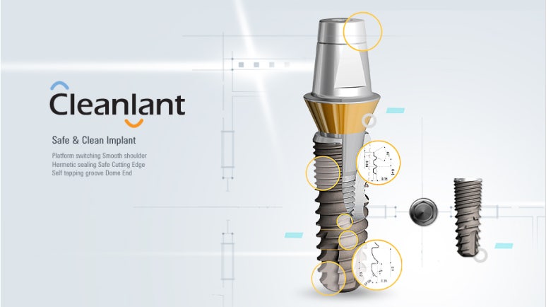 Implants Have Nothing to Do with Age. image 7