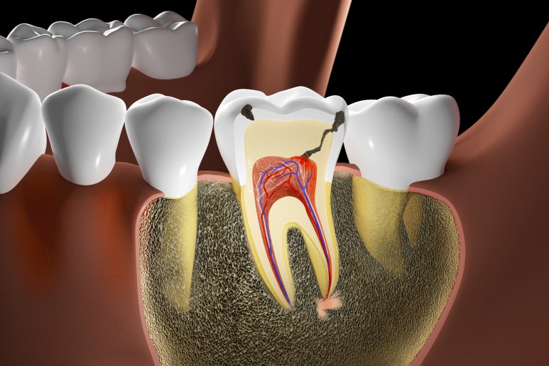 Are There Implants That Finish in One Day? image 1